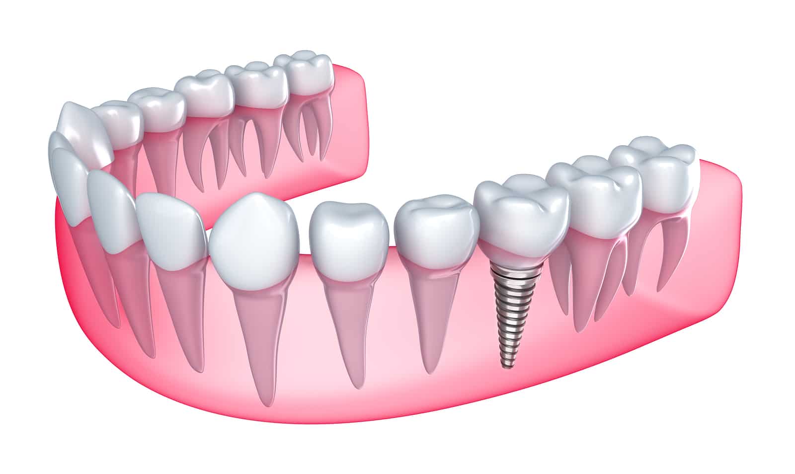 The Benefits of Dental Implants: Why They’re the Best Choice for Tooth Replacement