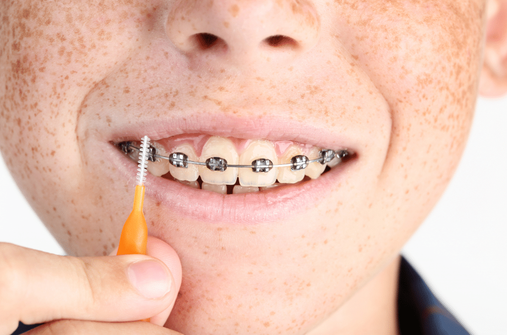 How Can Braces Help Your Teeth?