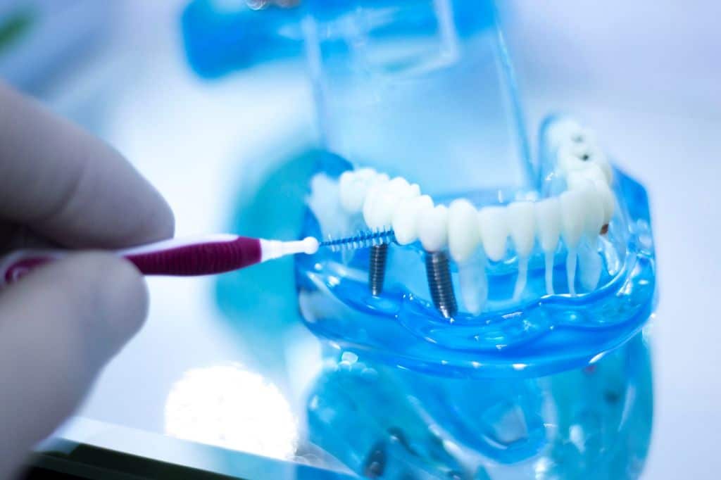 How Should You Take Care of Your Dental Implants?