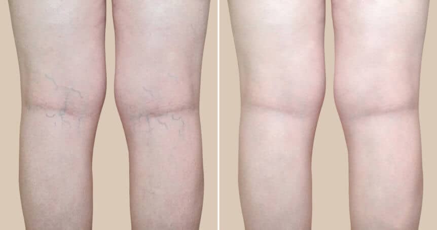 What to Anticipate Following Spider Vein Treatment