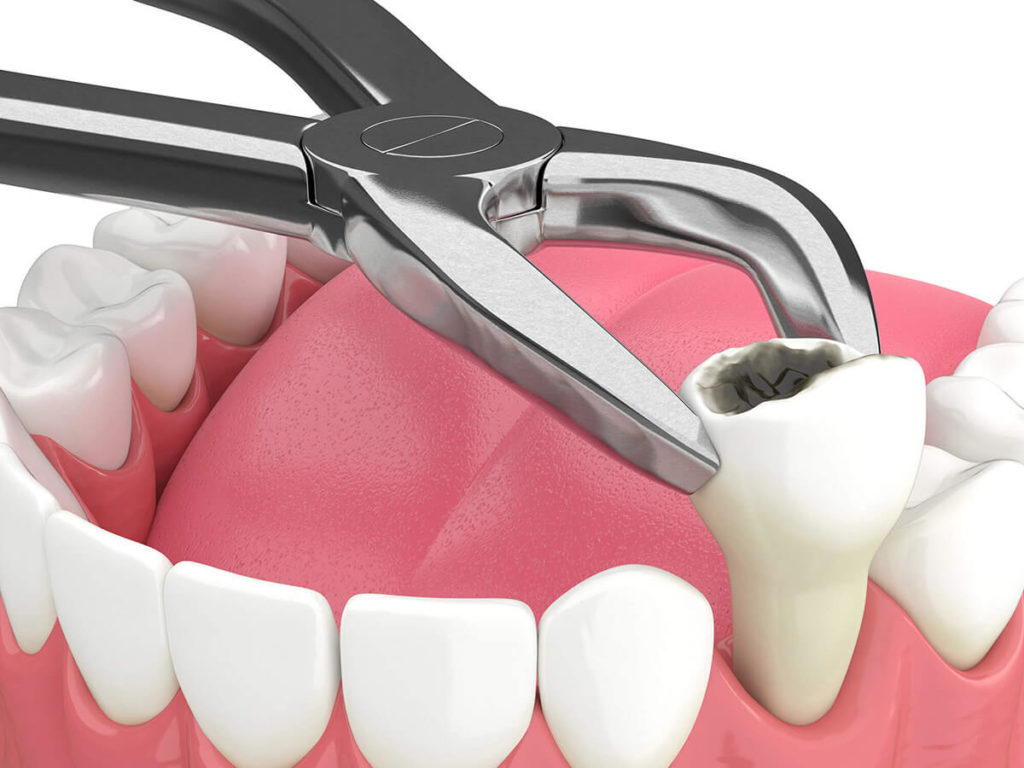 When and Why Dental Extractions are Necessary