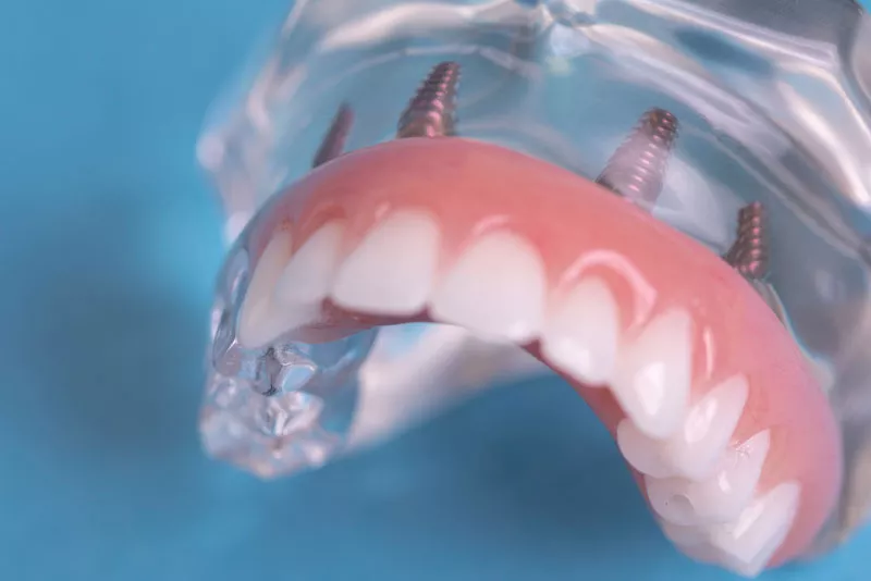 Full Arch Restorations with Subperiosteal Implants in Dexter: A Lifelike Smile Awaits