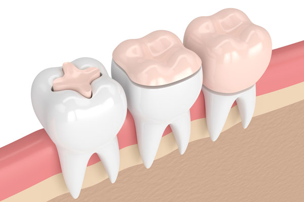What Are the Benefits of Having Your Teeth Restored?