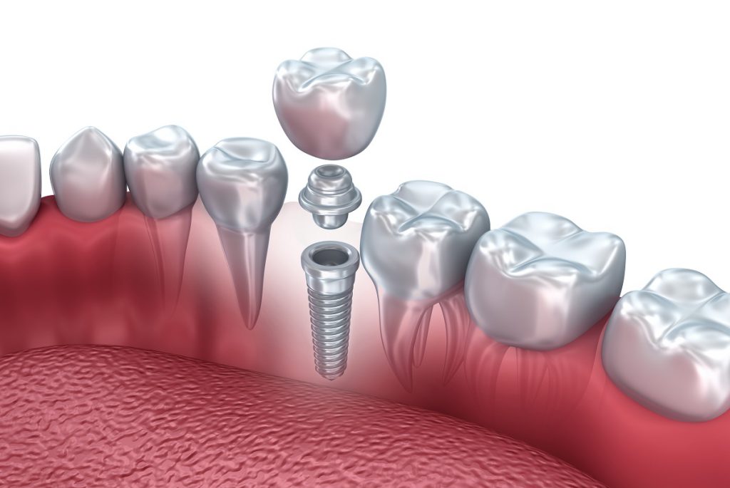Affordable Implant Options at Chicago Dental Implants