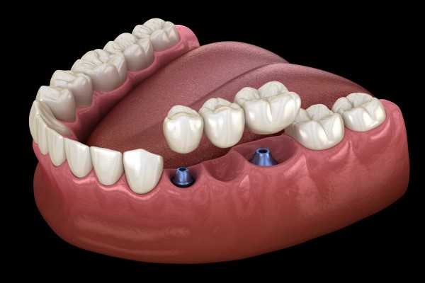 Enhancing Oral Health: Benefits of Dental Bridges