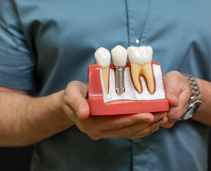 Understanding Dental Implants: Key Information