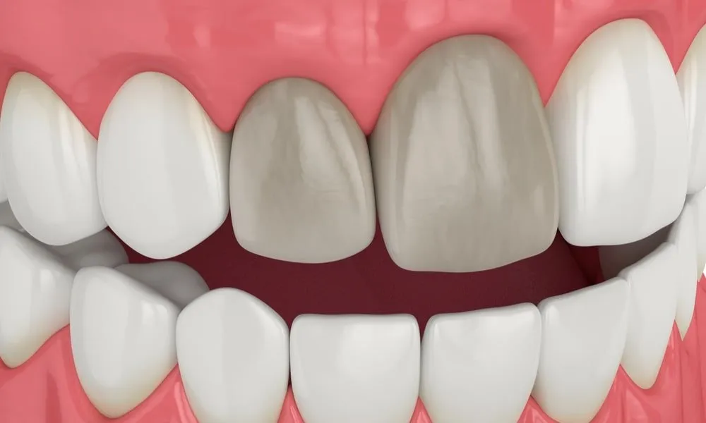 Tooth Discoloration